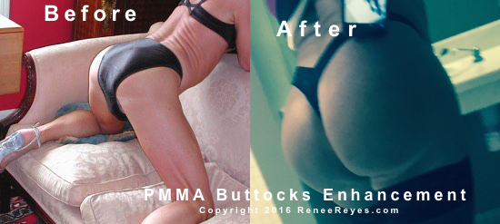 Before After Photos Hydrogel Injections